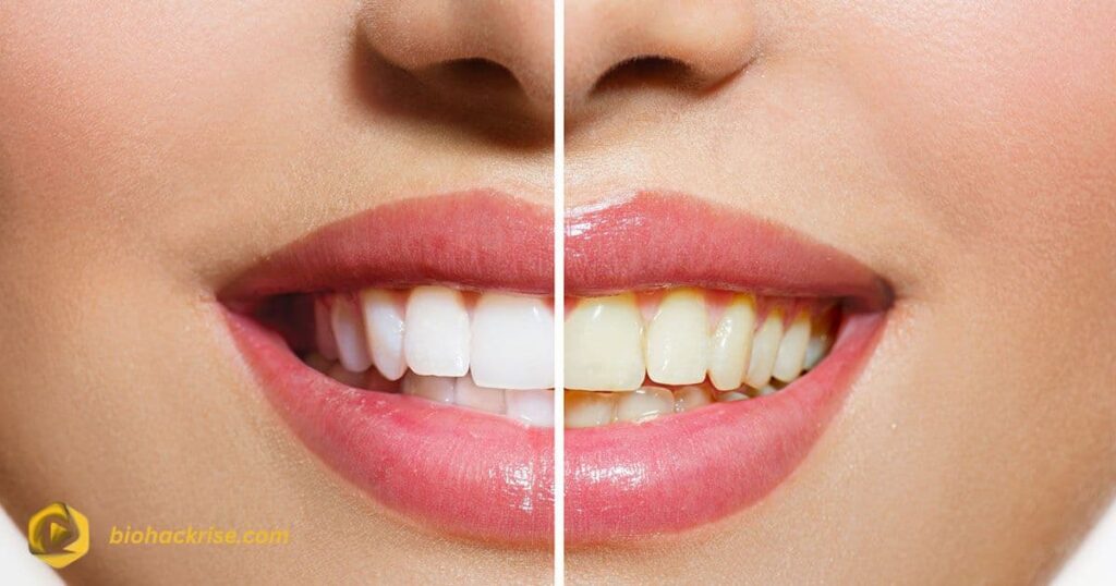 Before and After Veneers