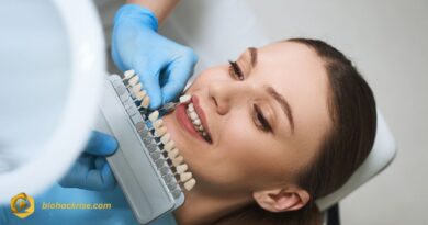 Teeth Before Veneers